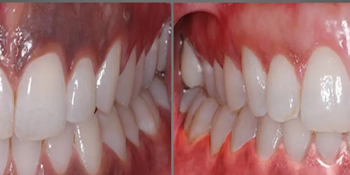 Depigmentation