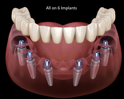 All in 6 implants
