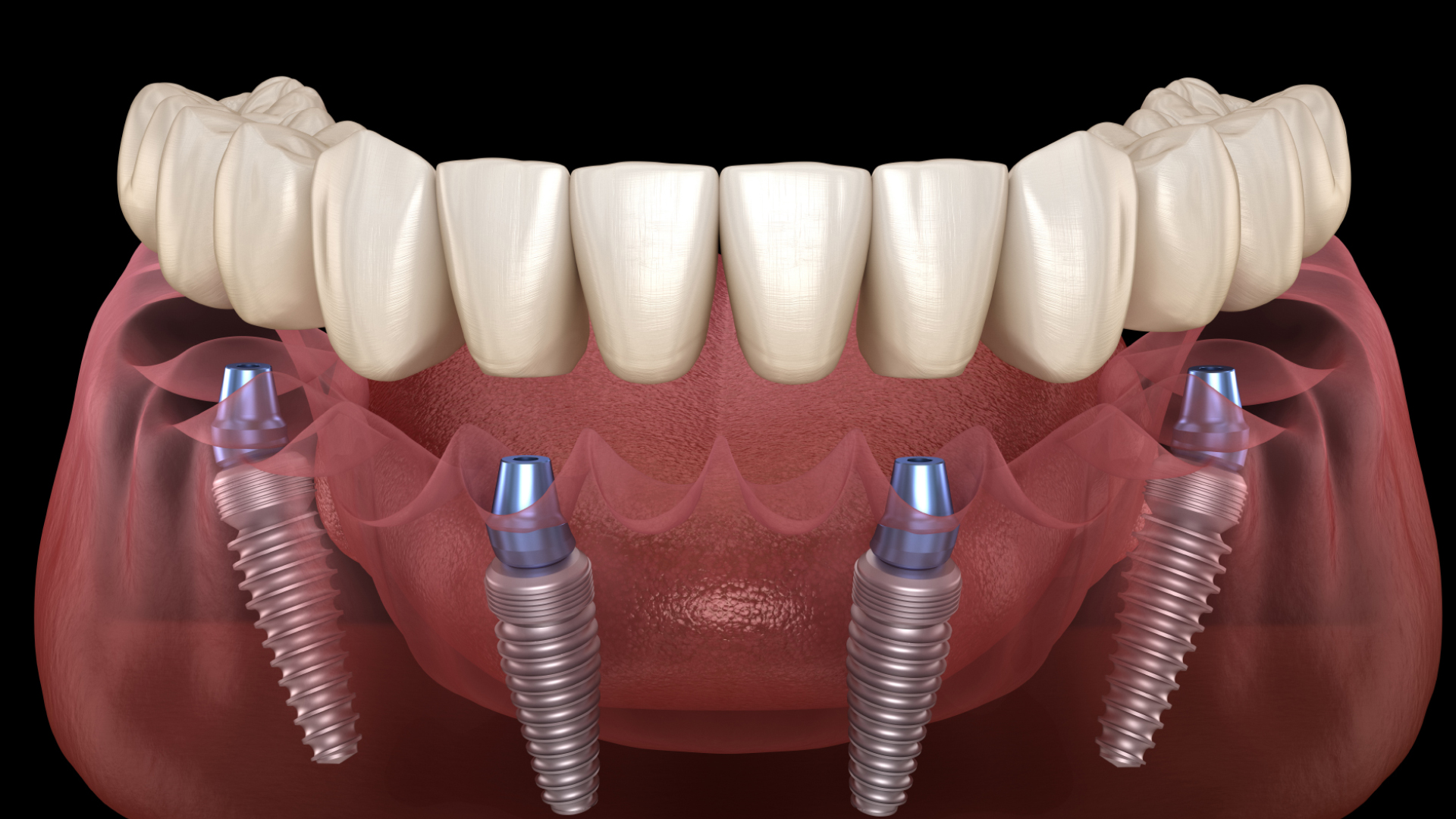 qdental