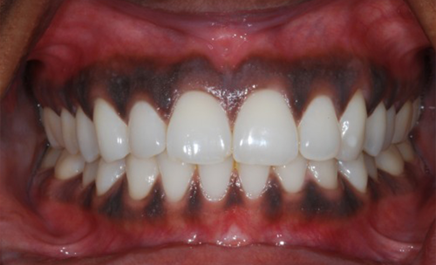 Gum Pigmentation