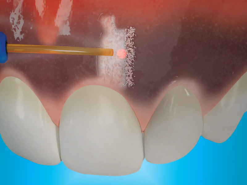 depigmentation