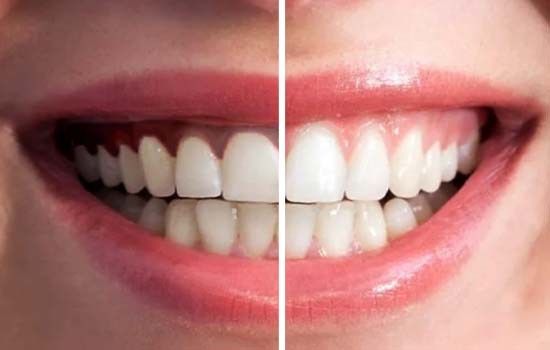 Depigmentation