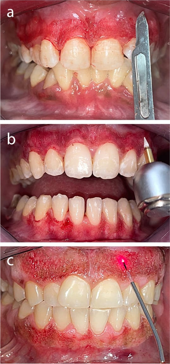 Depigmentation 