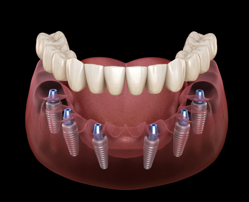 Full mouth implants