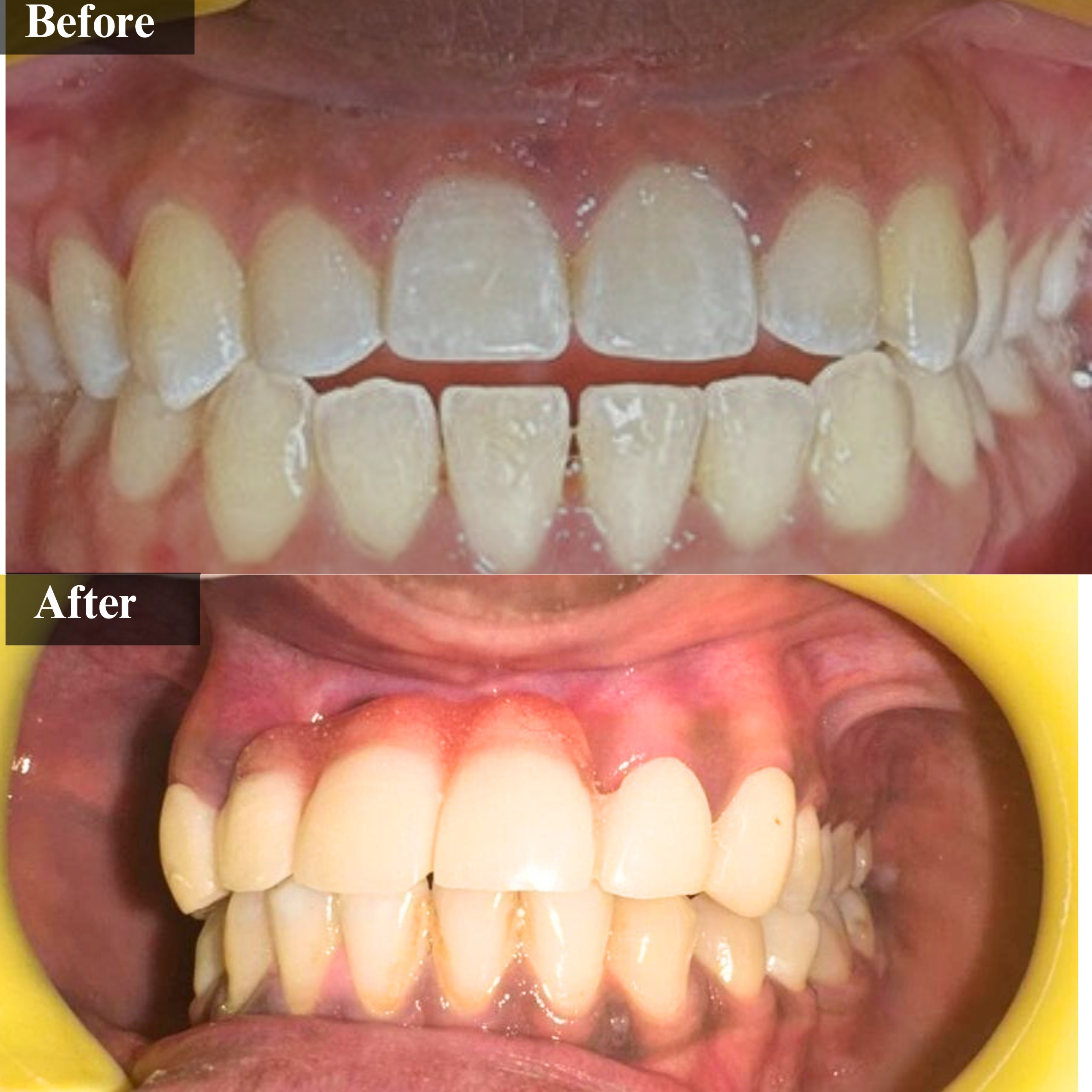 laser-RootCanal