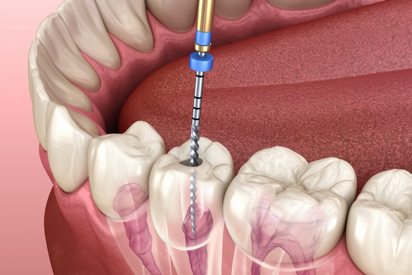 Root Canal is the treatment of choice to save teeth when decay or fracture has reached the nerve.