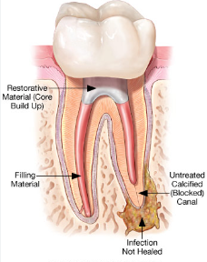 rootcanal