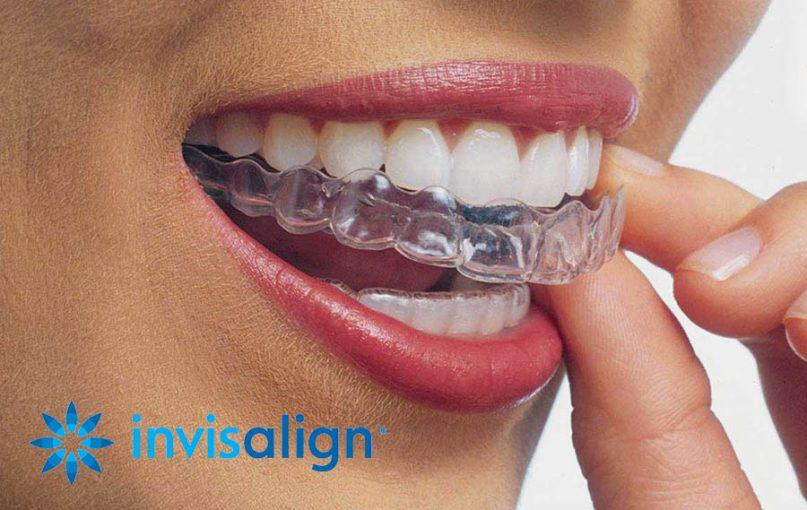  Aligners And Invisaligns