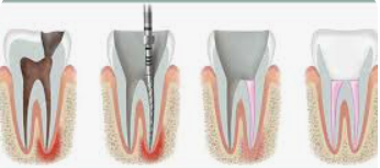 Full mouth implants