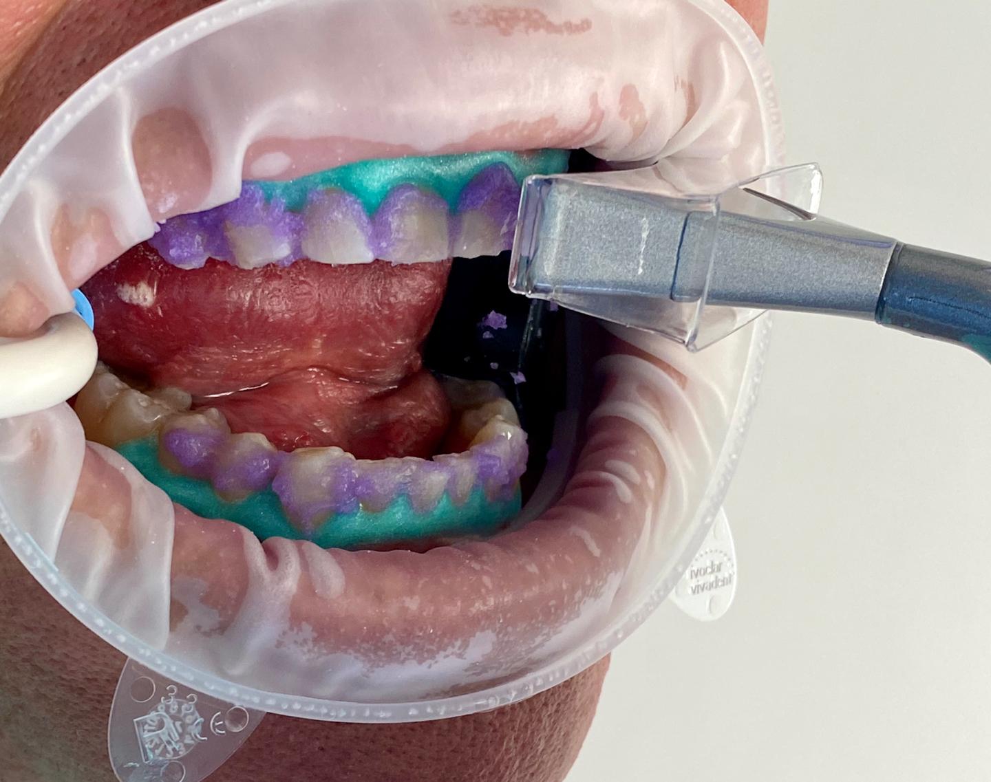 Full mouth implants