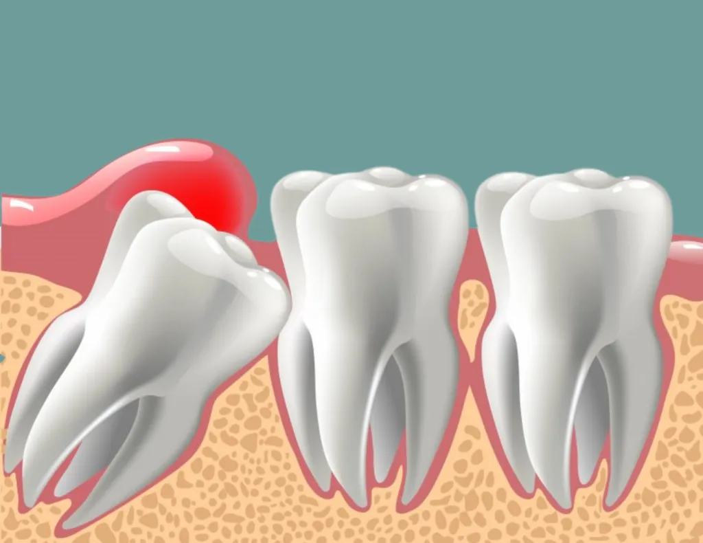 wisdom tooth